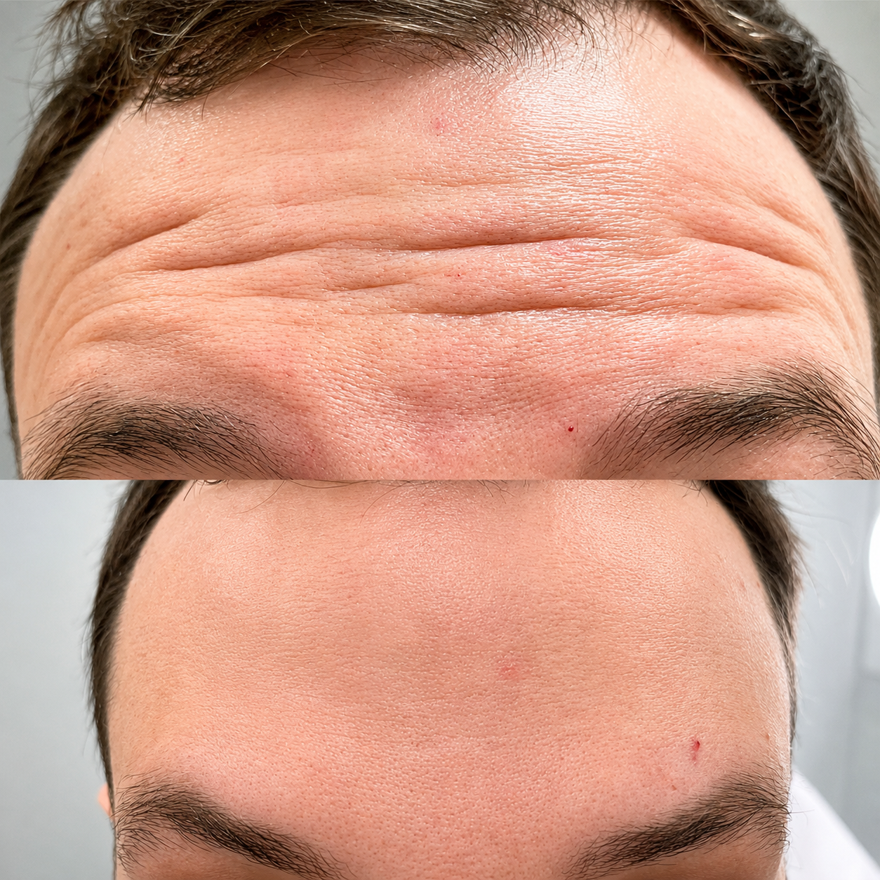 Aplicação de Botox