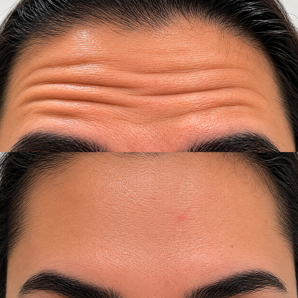 Procedimento de Botox