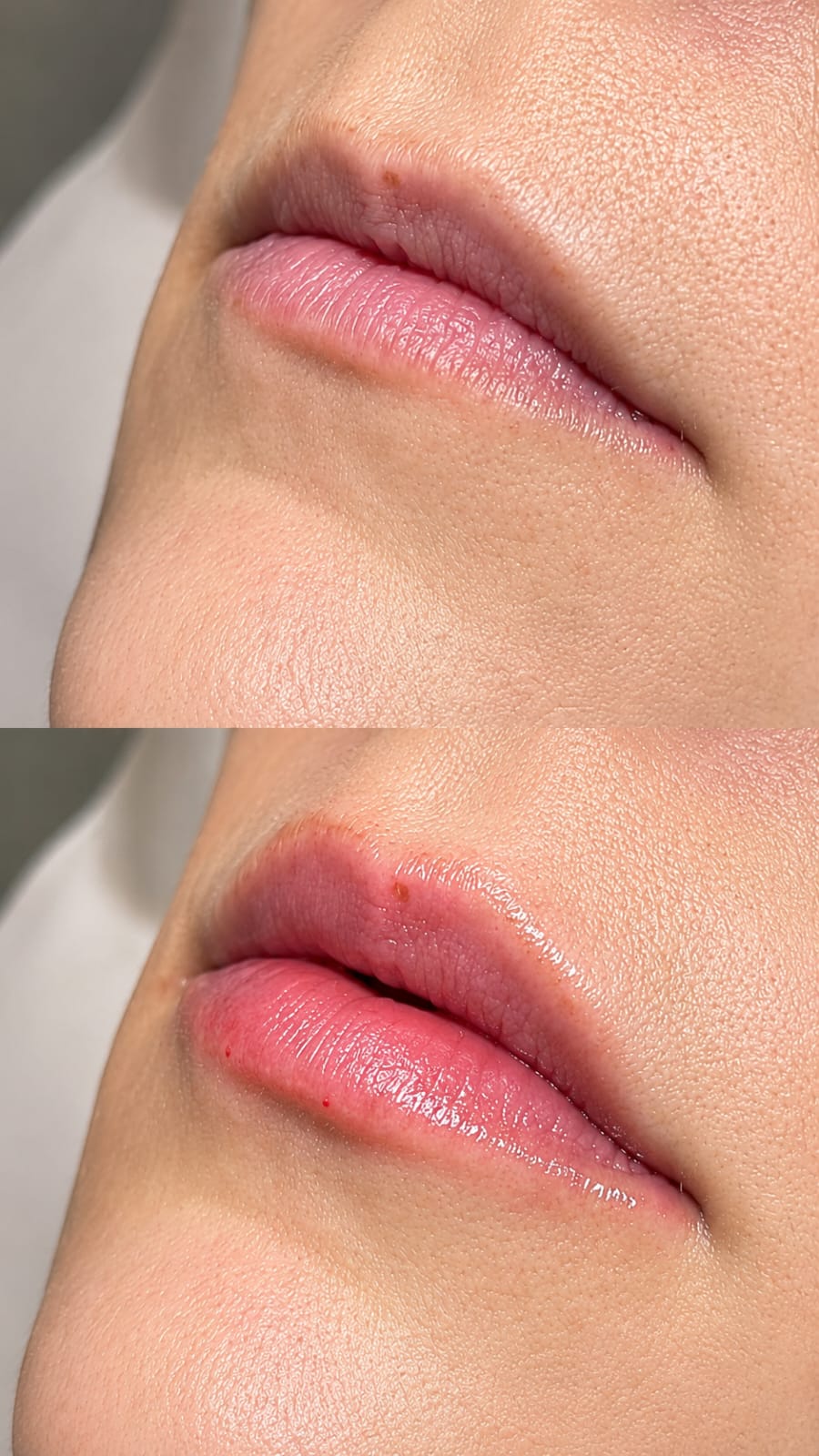 Preenchimento Labial